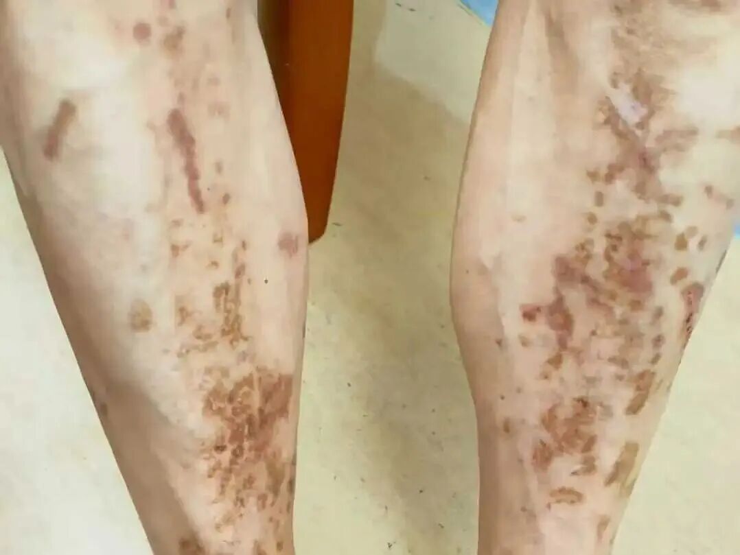 腿脚正在发出“血糖失控”警报！这6个表现，出现一个就要当心