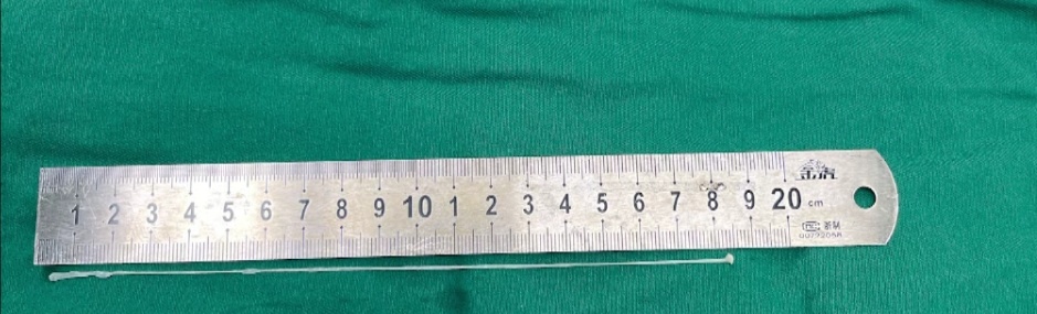 男子眼前频现“幻灯片”，“会从左眼穿过去”！开颅手术发现……