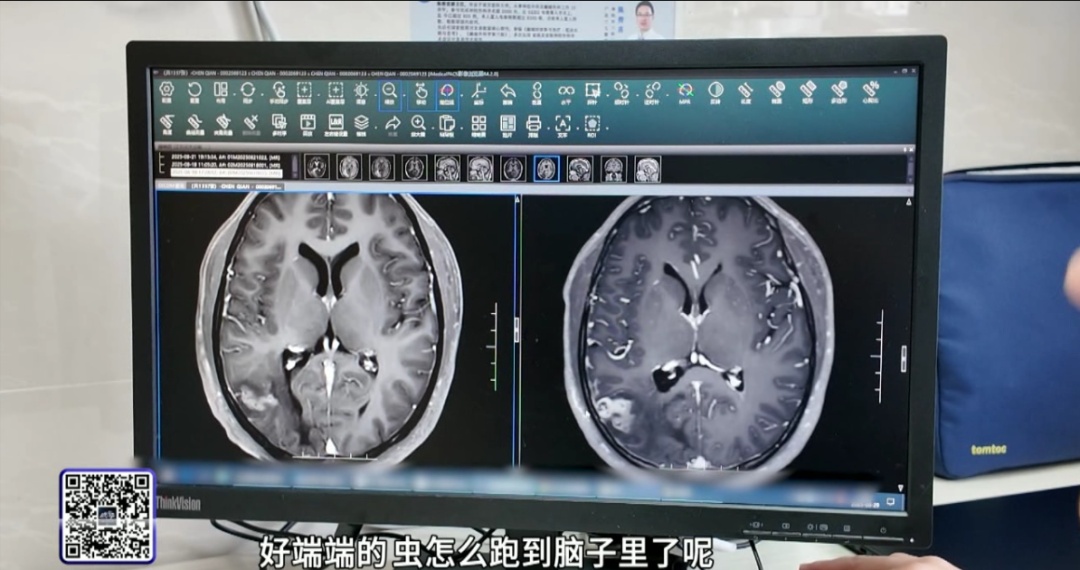 男子眼前频现“幻灯片”，“会从左眼穿过去”！开颅手术发现……