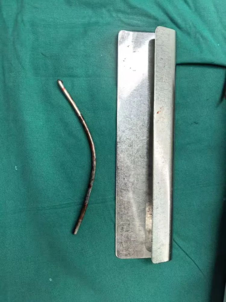 温州一男子膝盖被戳穿!连主刀医生都直呼“活久见” 温州一男子膝盖被戳穿!连主刀医生都直呼“活久见”