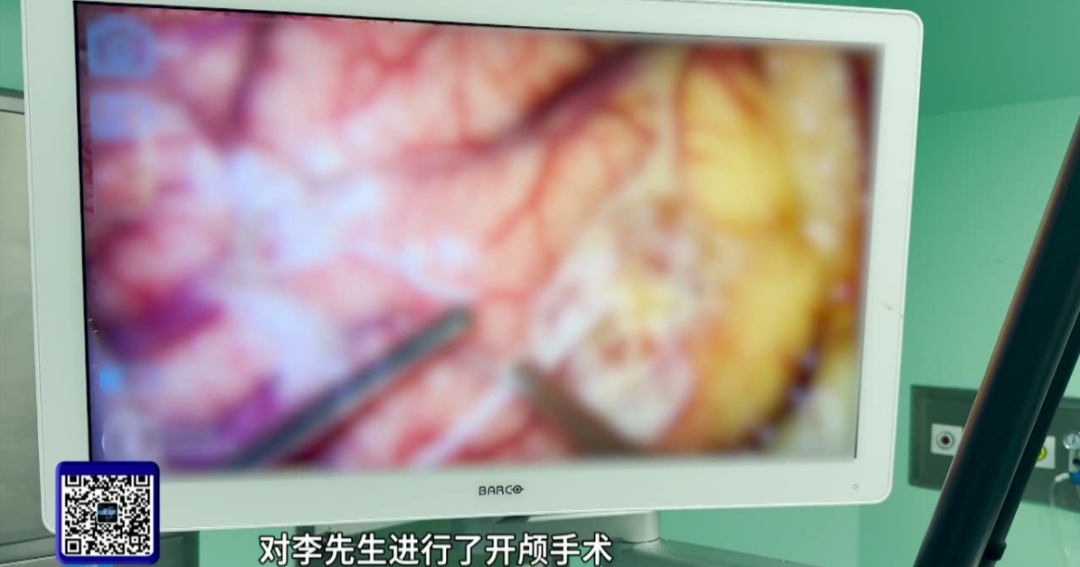 男子眼前频现“幻灯片”，“会从左眼穿过去”！开颅手术发现……