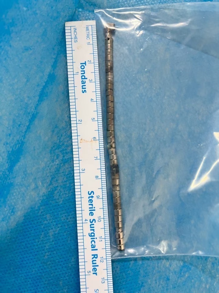 惊险！3岁幼童误吞40多颗磁力珠致食管和胃底穿孔，医生提醒：严重可危及生命