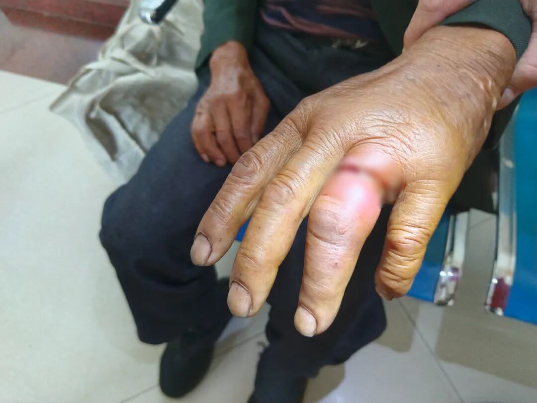 急诊求救！戒指勒进肉中，老人遭罪“惊动”119……