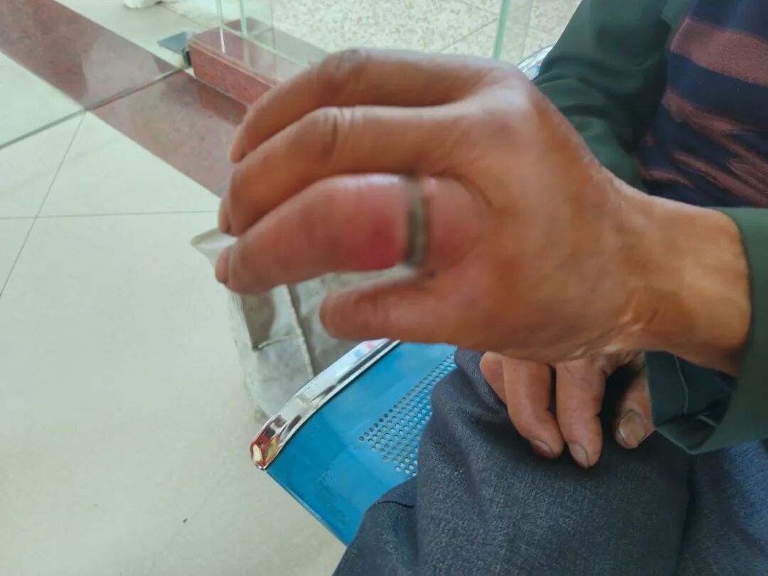 急诊求救！戒指勒进肉中，老人遭罪“惊动”119……