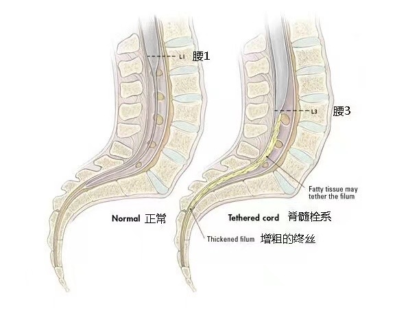 背后长了一团，8岁女孩竟然“返祖”了！这种病千万不能拖，严重可致瘫痪