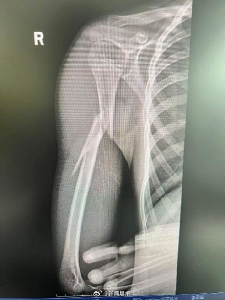 10岁男孩取洗衣机衣物右臂卷入 致粉碎性骨折！医生提醒