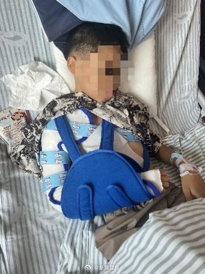 10岁男孩取洗衣机衣物右臂卷入 致粉碎性骨折！医生提醒