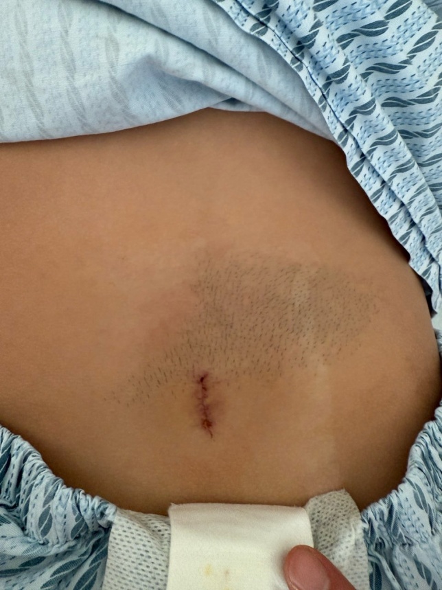 背后长了一团，8岁女孩竟然“返祖”了！这种病千万不能拖，严重可致瘫痪