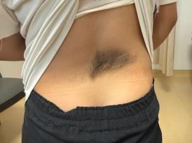 背后长了一团，8岁女孩竟然“返祖”了！这种病千万不能拖，严重可致瘫痪