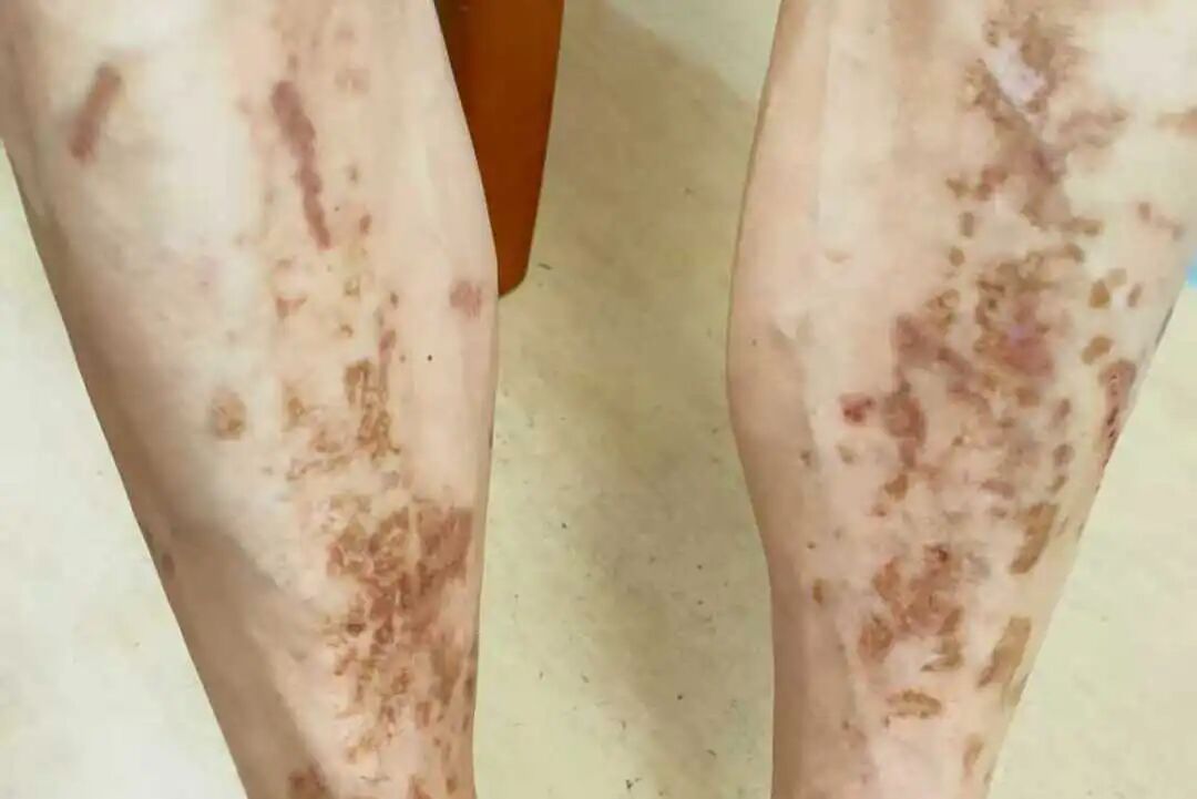 小腿出现这种斑，竟是身体在“求救”！很多人误以为是……