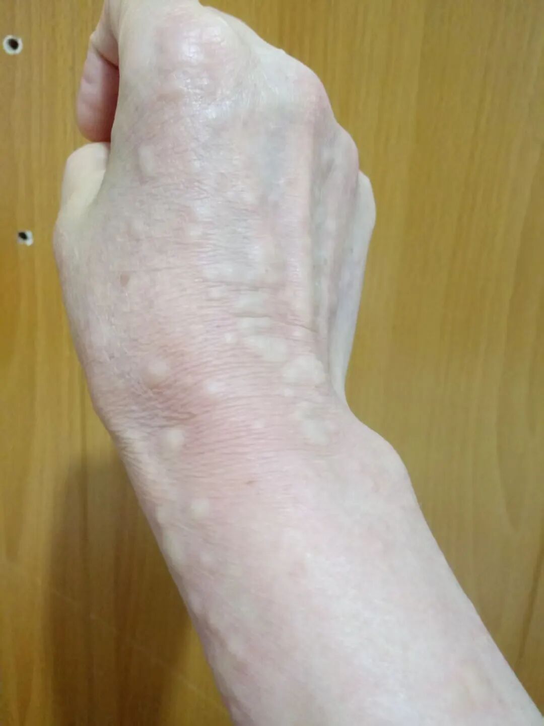 半夜醒来，床单上全是血！像有蚂蚁在骨头缝里爬！杭州55岁阿姨：没想到竟是它惹的祸…