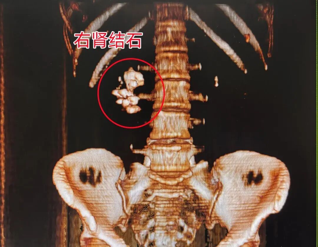 十年隐忍不敌一刻剧痛!女子肾门被2.2厘米结石“堵死” 十年隐忍不敌一刻剧痛!女子肾门被2.2厘米结石“堵死”