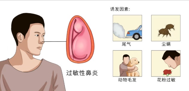 每天被喷嚏叫醒?鼻炎患者:中医这几招亲测有效 每天被喷嚏叫醒?鼻炎患者:中医这几招亲测有效