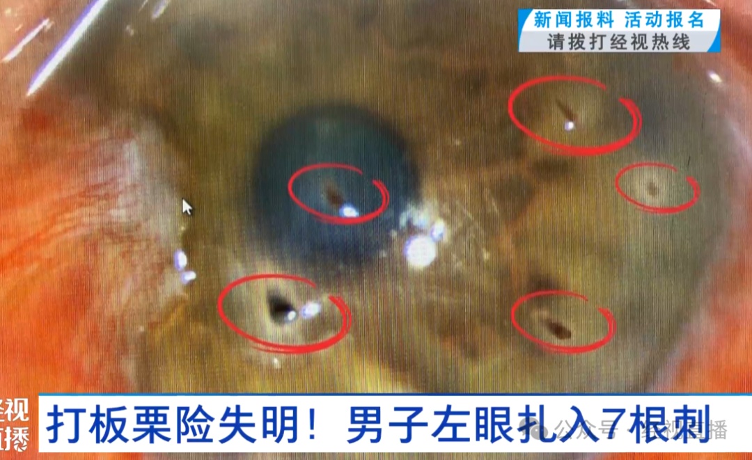 揪心！武汉一男子眼球扎入7根刺，差点失明！医生：每年9月高发