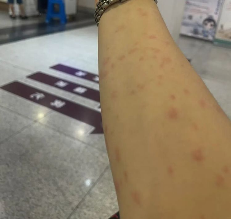 “密密麻麻！”富阳女子接连中招，很多人在用……医生：赶紧停掉