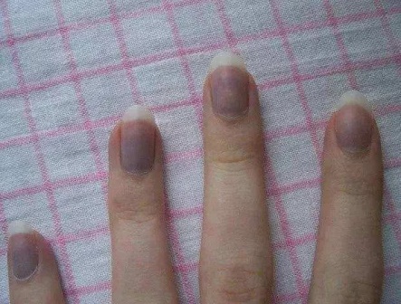 别忽视!指甲上的这个异样,竟可能是疾病征兆? 别忽视!指甲上的这个异样,竟可能是疾病征兆?