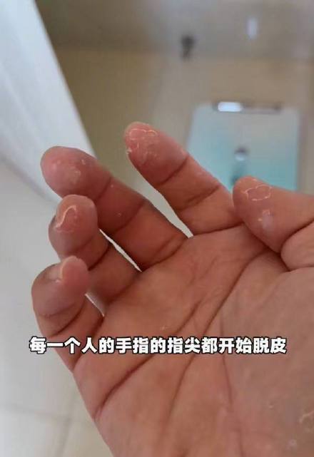 北极圈徒步后得了“指尖脱皮症”？医生：或与长时间戴手套有关