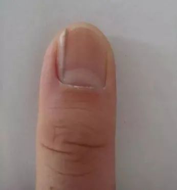 别忽视!指甲上的这个异样,竟可能是疾病征兆? 别忽视!指甲上的这个异样,竟可能是疾病征兆?