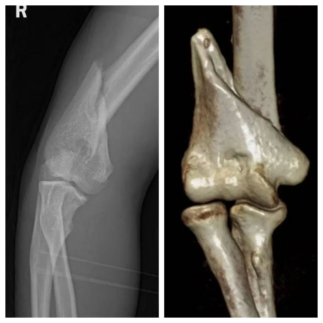 小伙猛地发力后"咔嚓"一声,这部位当场报废!医生:别再瞎较劲! 小伙猛地发力后"咔嚓"一声,这部位当场报废!医生:别再瞎较劲!