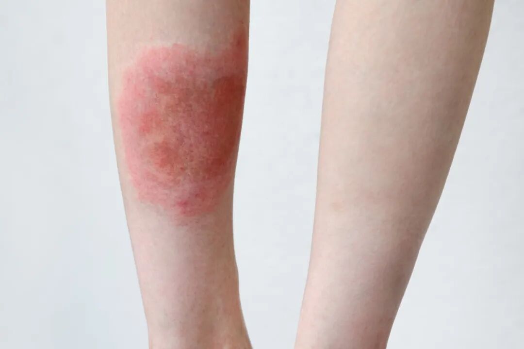 当心被它叮咬！已有人被送进ICU