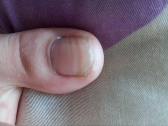 别忽视!指甲上的这个异样,竟可能是疾病征兆? 别忽视!指甲上的这个异样,竟可能是疾病征兆?