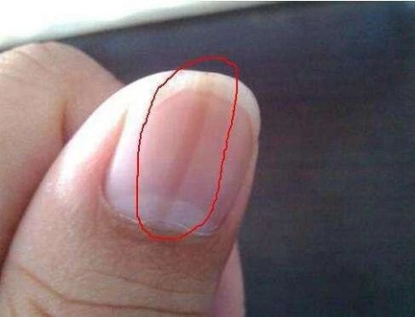 别忽视!指甲上的这个异样,竟可能是疾病征兆? 别忽视!指甲上的这个异样,竟可能是疾病征兆?