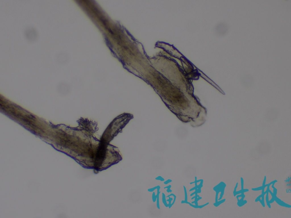 福建女子常常熬夜干这事，医生一看惊了：这个地方爬满虫……