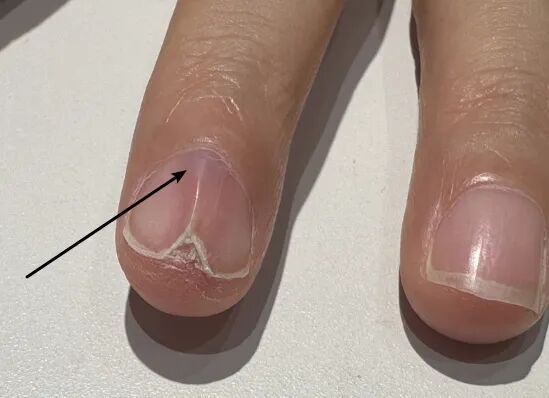 指甲上没有月牙，是我身体虚吗？