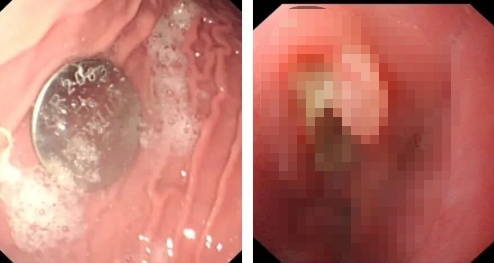 1岁半孩子的食道因TA腐蚀穿孔!家中的“小圆片”快收好 1岁半孩子的食道因TA腐蚀穿孔!家中的“小圆片”快收好