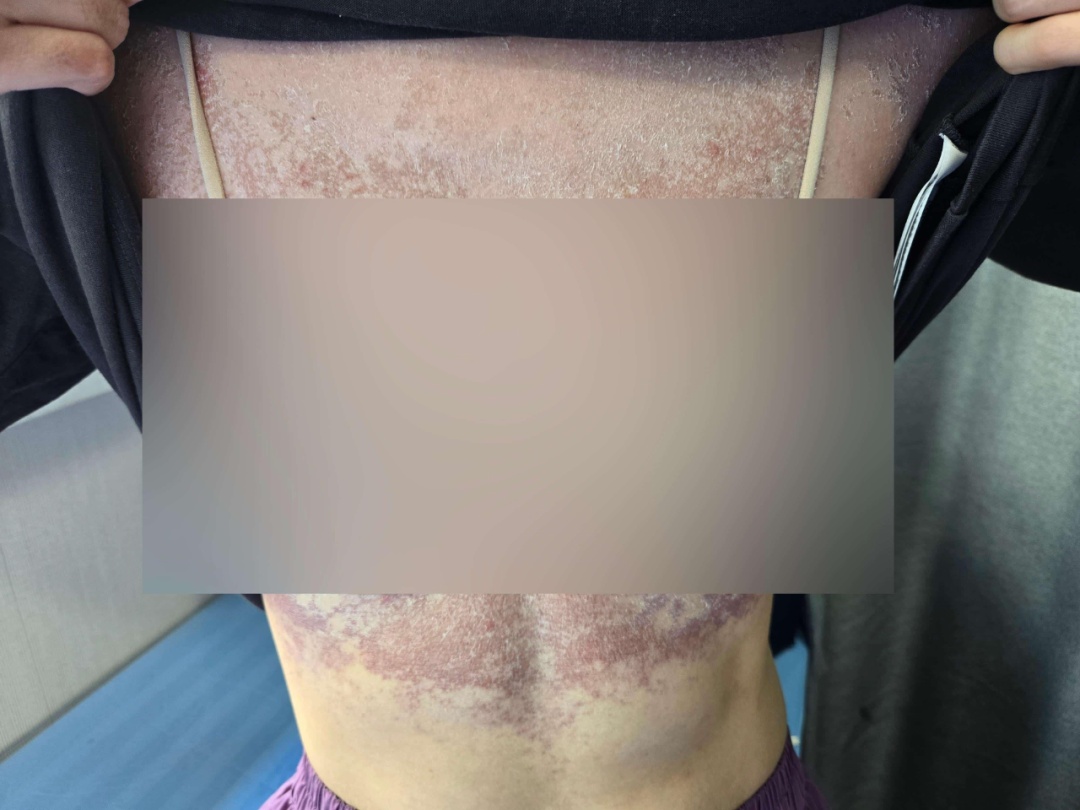 浙江一对母子相继患“怪病”，红斑爬满全身痒得无法睡觉！元凶是它，很多人家里在用…