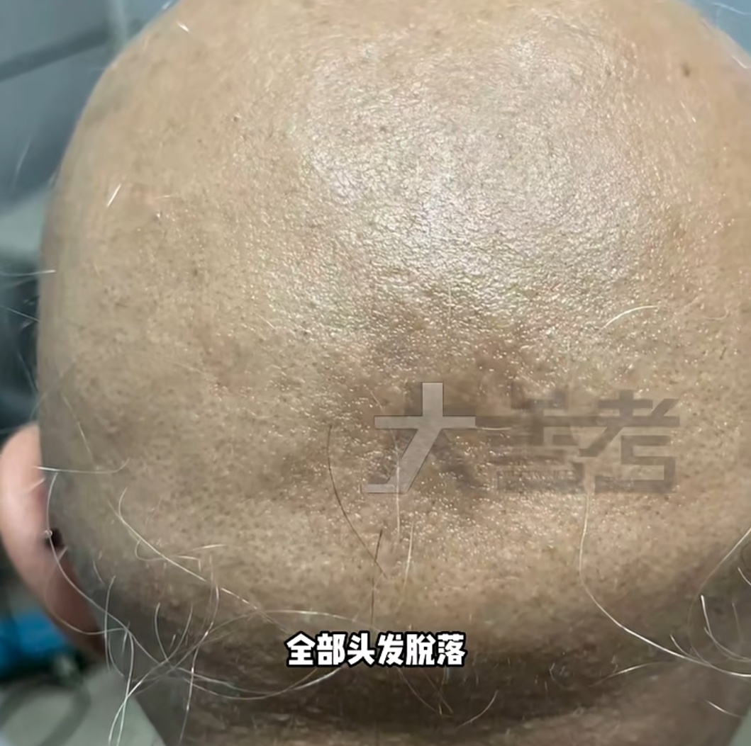 20岁女孩失恋一个月，毛发突然全部脱落！医生提醒→