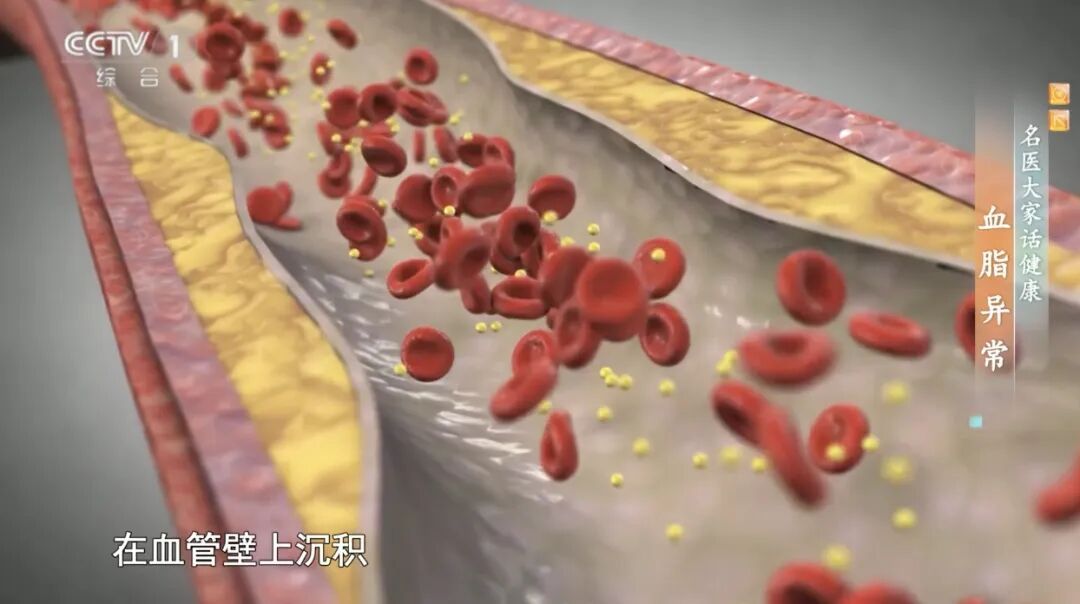 晨起后有这5个表现,你的血脂可能高了!做好这5点,帮你稳住血脂 晨起后有这5个表现,你的血脂可能高了!做好这5点,帮你稳住血脂