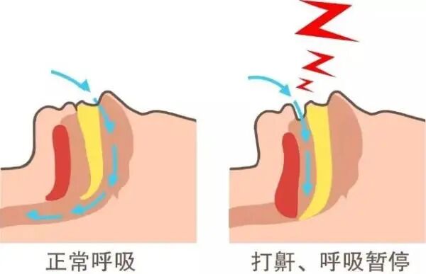 睡眠呼吸暂停:别把打鼾当小事 睡眠呼吸暂停:别把打鼾当小事