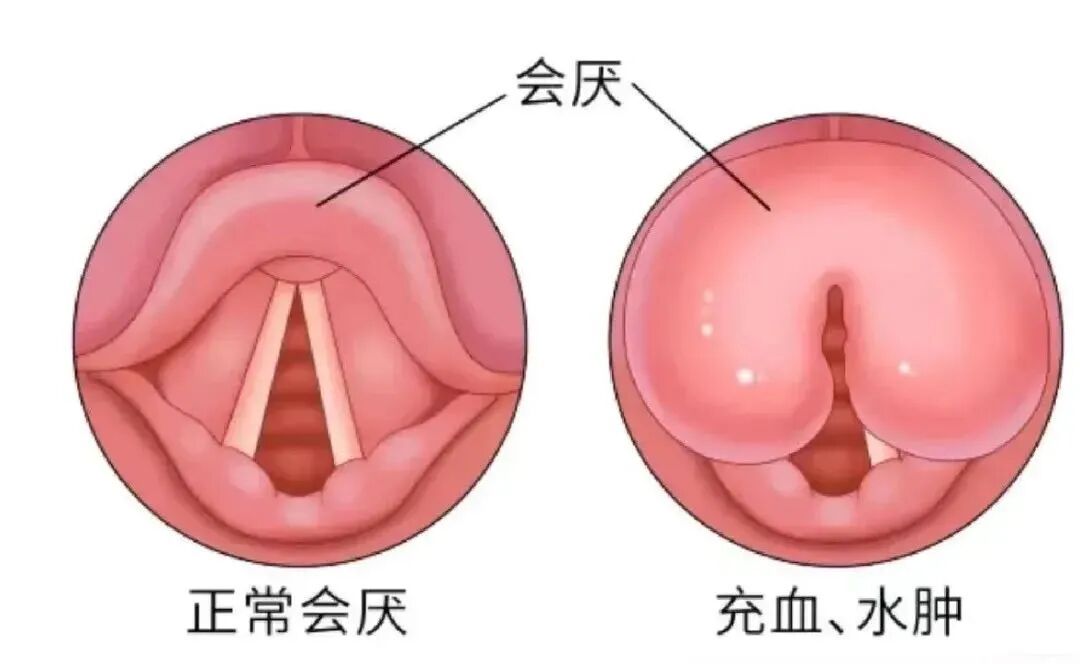 不是感冒！男子“刀片嗓”硬扛一夜差点丧命，医生警告……