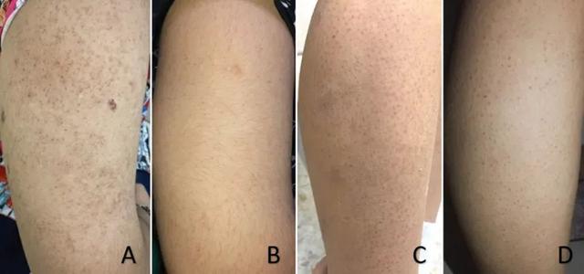 快住手！这些小颗粒真不是痘痘，别抠！也别随便用药！