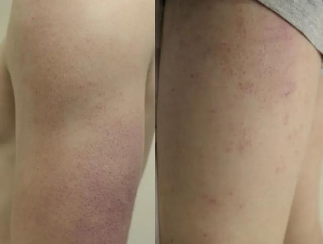 快住手！这些小颗粒真不是痘痘，别抠！也别随便用药！