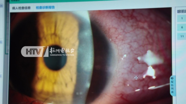 杭州8岁男孩感染罕见寄生虫，很多人家里都有！医生：我从业20多年第一次见……