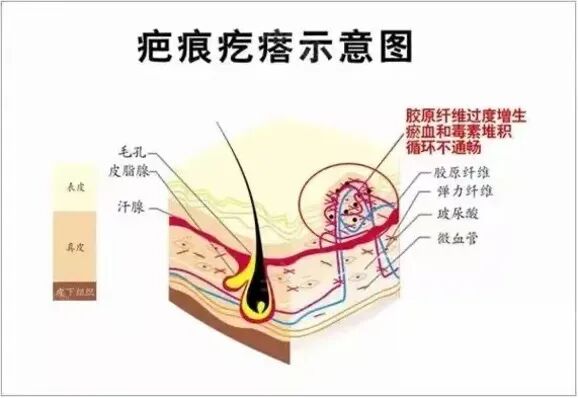 拆线后伤口就万事大吉了吗？疤痕护理不可忽视!