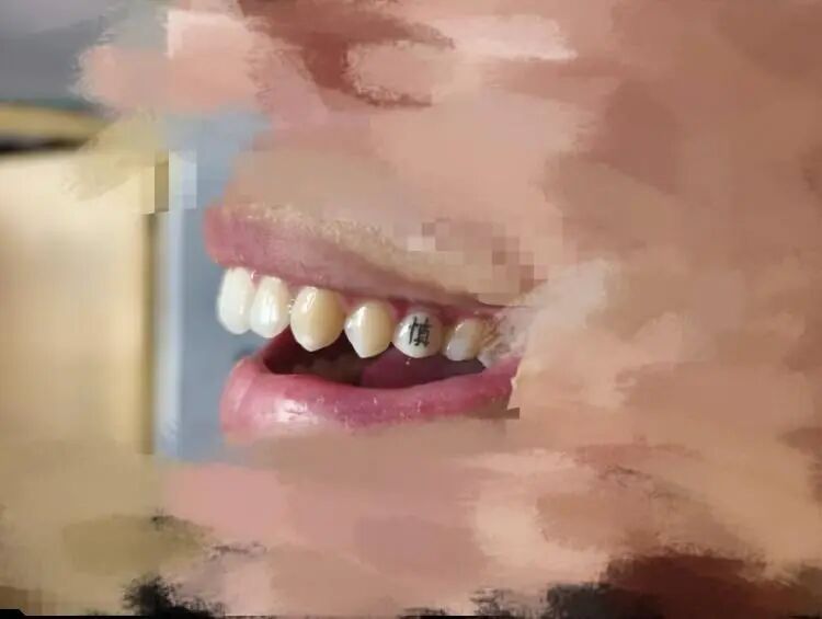 牙齿也能“文身”？口腔不是许愿池，医生提醒：不建议临床使用！