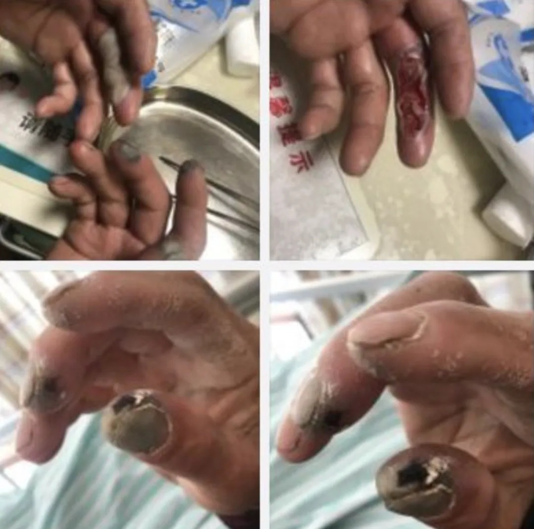 52岁女子出门散步，却中毒身亡！这种化学品被称为“化骨水”，具有极强腐蚀性