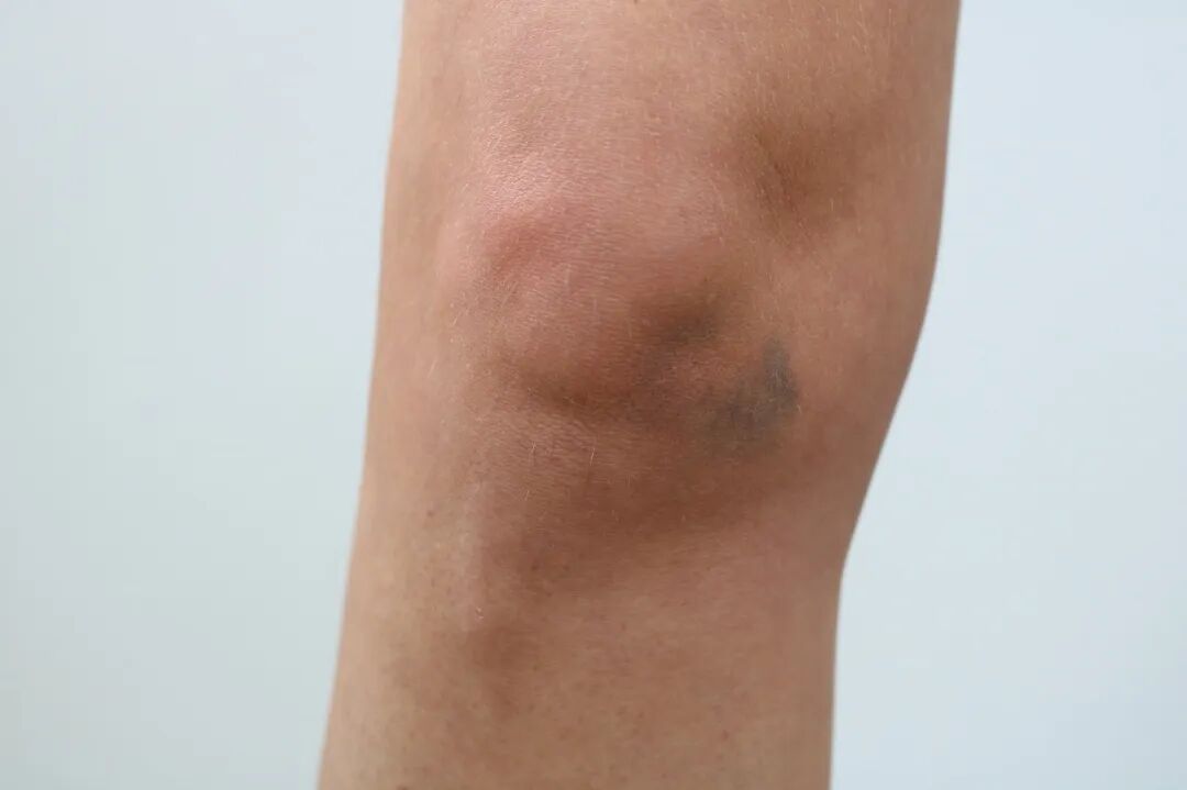 身上莫名出现的淤青，警惕！可能是这4种疾病……