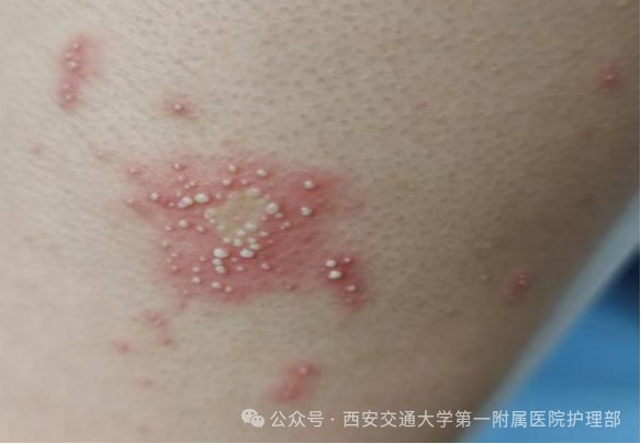 西安多区发现隐翅虫？千万别拍！毒液堪比硫酸