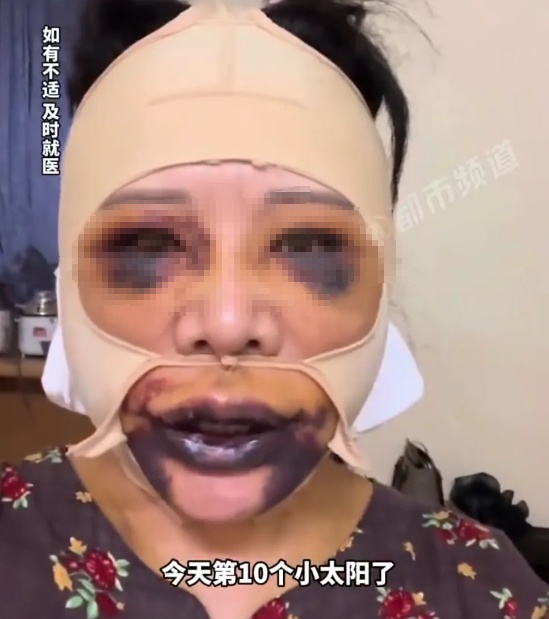 上海58岁女子整容后肿成“熊猫”！面部大片淤血，眼睛和嘴巴肿胀发紫！10天还未恢复