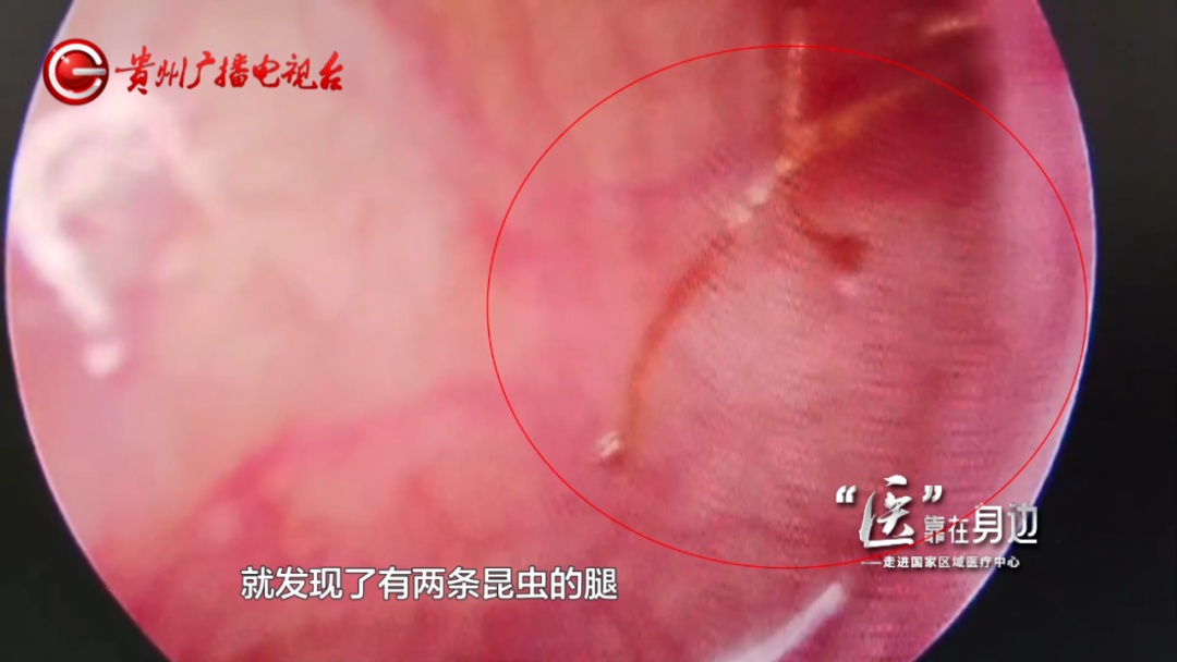 贵州一女子耳朵钻心的痛，医生揪出“真凶”！竟然是一只……