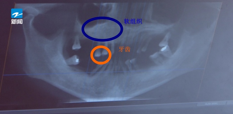 浙江44岁女子牙齿掉光！只因这个很多人都忽视的“小问题”…医生紧急提醒