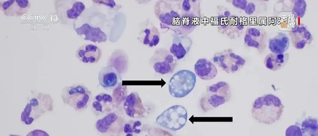 印度一地19人死于“食脑虫”感染 印度一地19人死于“食脑虫”感染
