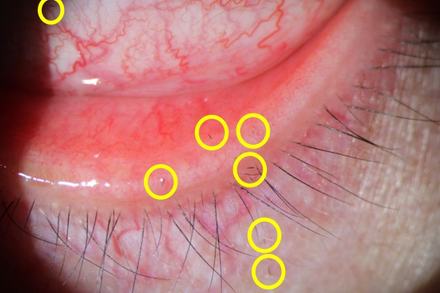 一阵风吹过,女子眼睛被扎入7根“黑刺”!比针尖还细!千万要注意...... 一阵风吹过,女子眼睛被扎入7根“黑刺”!比针尖还细!千万要注意......