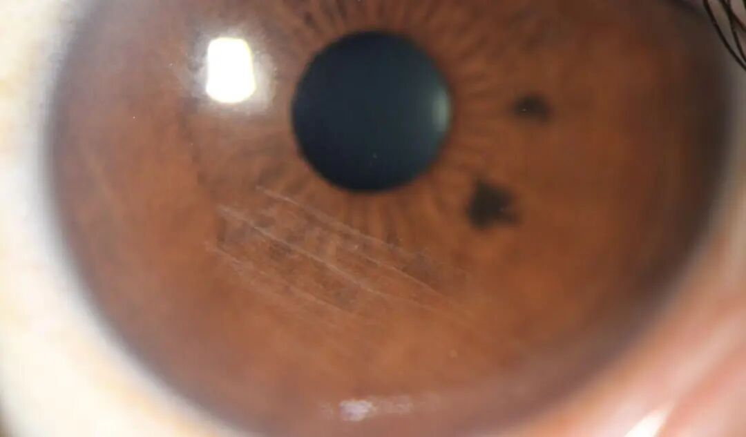 一阵风吹过,女子眼睛被扎入7根“黑刺”!比针尖还细!千万要注意...... 一阵风吹过,女子眼睛被扎入7根“黑刺”!比针尖还细!千万要注意......