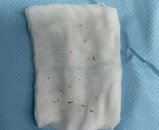 一阵风吹过,女子眼睛被扎入7根“黑刺”!比针尖还细!千万要注意...... 一阵风吹过,女子眼睛被扎入7根“黑刺”!比针尖还细!千万要注意......