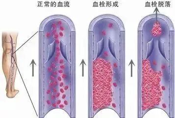 险些截肢,接连十余人确诊!这个习惯很多人都有 险些截肢,接连十余人确诊!这个习惯很多人都有